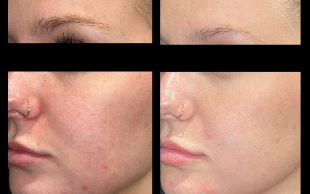 Introducing the Hollywood Spectra Laser Peel in Knoxville, TN