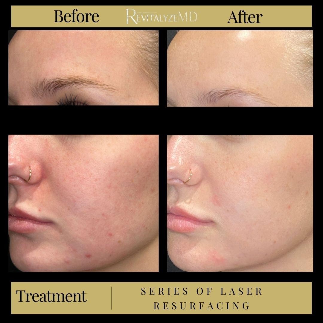 Introducing the Hollywood Spectra Laser Peel in Knoxville, TN