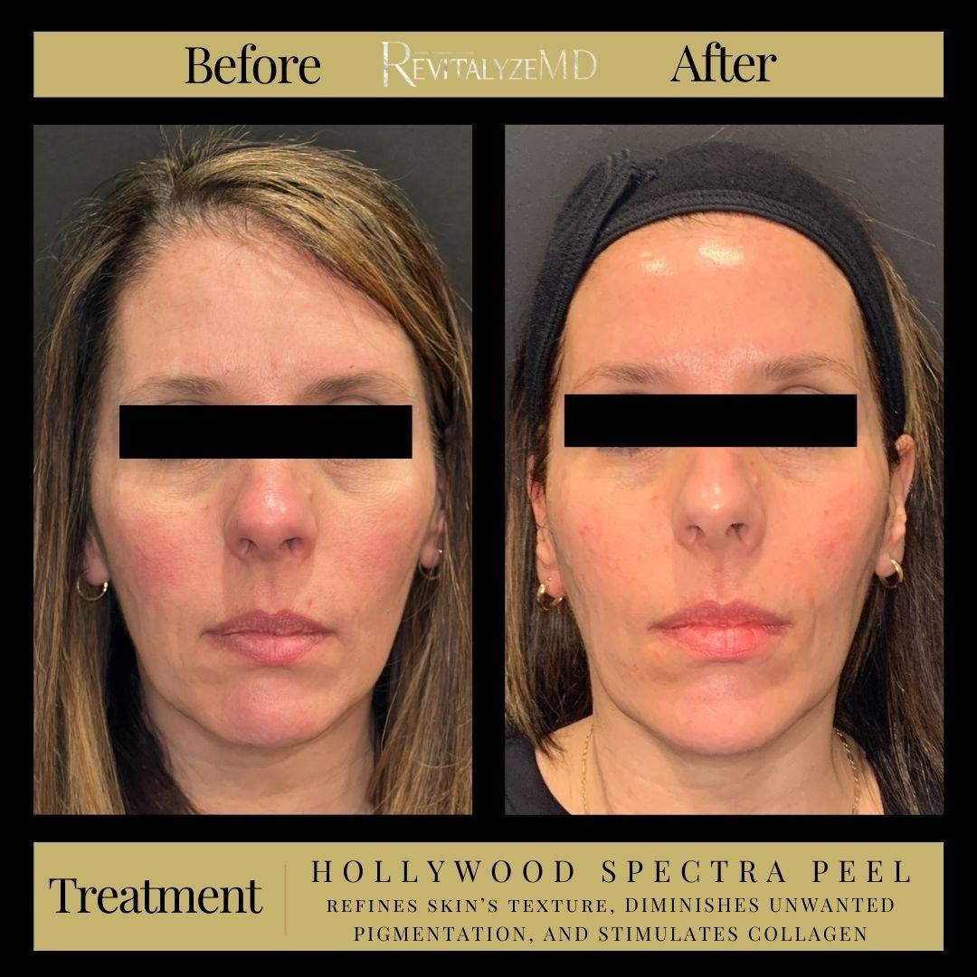 Ideal Candidates for the Hollywood Spectra Laser Peel in Knoxville, TN: