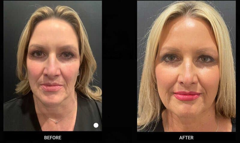 Do Dermal Fillers Get A Bad Rap?