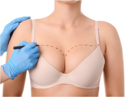 Minimizing Breast Surgery Scars with Morpheus8 in Knoxville